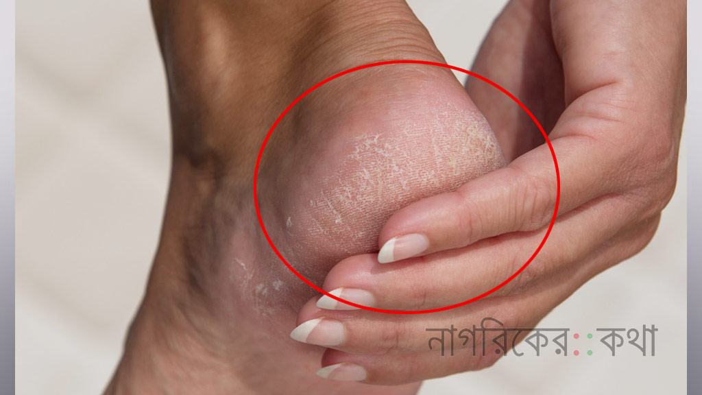 শীতের আগেই পা ফাটার সমস্যা? জেনে নিন করণীয়